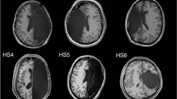 Blog de la Ciencia; ¿Cómo funciona el cerebro cuando falta un hemisferio?