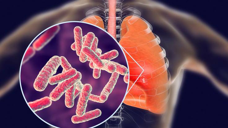 El Blog de la Ciencia; Primer paso para combatir la tuberculosis