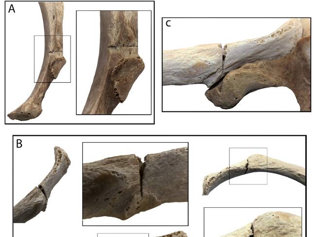 A: Vista interior de la tercera costilla y detalle del corte. B: Diferentes vistas y detalles del corte en la cuarta costilla izquierda.
C: Detalle del corte en la cuarta costilla izquierda, que también afecta a la vértebra T-4.
