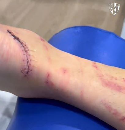 Óscar Sielva recibió 12 puntos de sutura en un talón