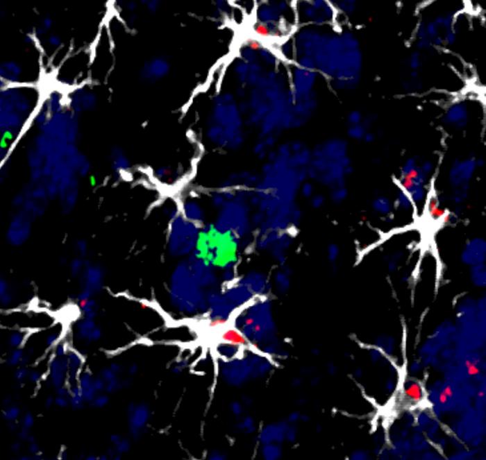 Células alrededor de una metástasis cerebral en un modelo animal: varias células cerebrales (astrocitos, blanco) rodean a una célula del sistema inmunitario (linfocito, verde). Algunos de ellos han comenzado a activar la molécula inductora del factor (rojo) TIMP1, que les permitirá desactivar la acción del linfocito frente a las células tumorales.