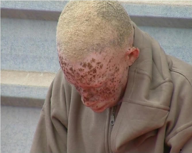 Moszy de 18 años es africano y albino, ha solicitado asilo político a España ya que afirma que en su país es perseguido para utilizar su cuerpo en rituales de brujería