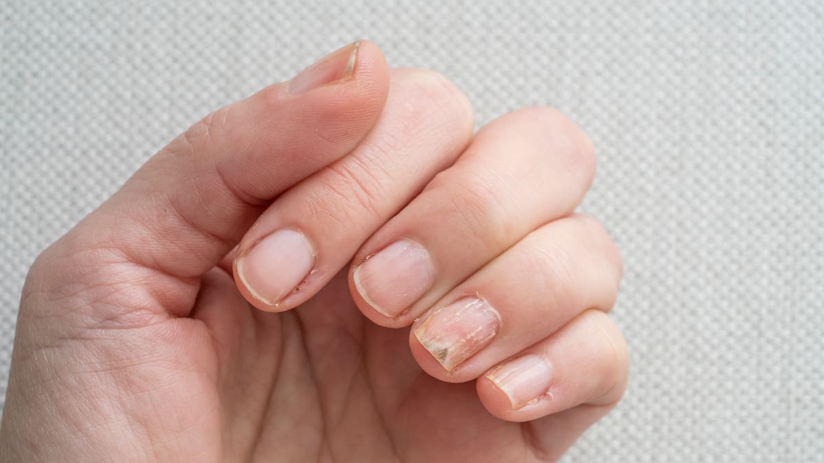 El "eje cerebro-piel": por qué el estrés puede arruinar la estructura de tus uñas o provocar brotes de acné