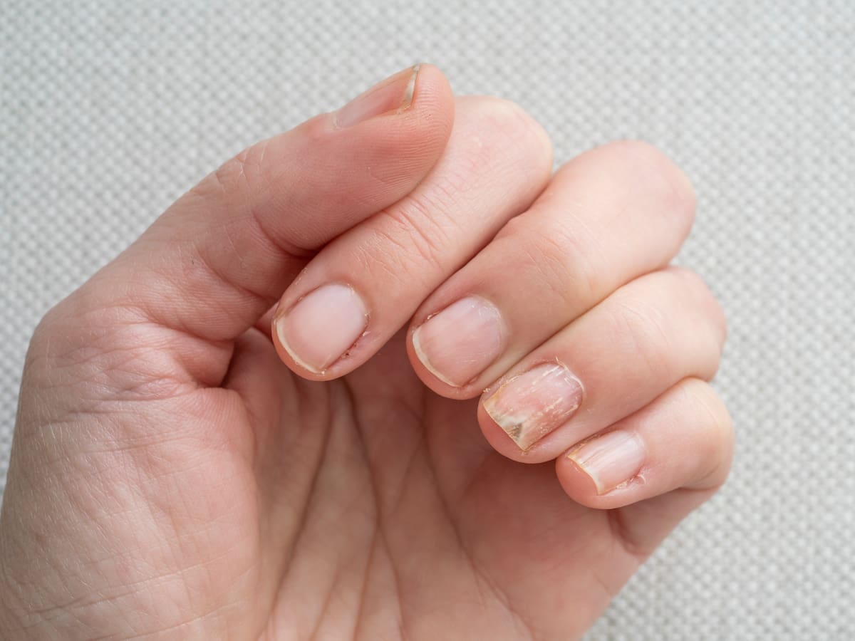 El "eje cerebro-piel": por qué el estrés puede arruinar la estructura de tus uñas o provocar brotes de acné