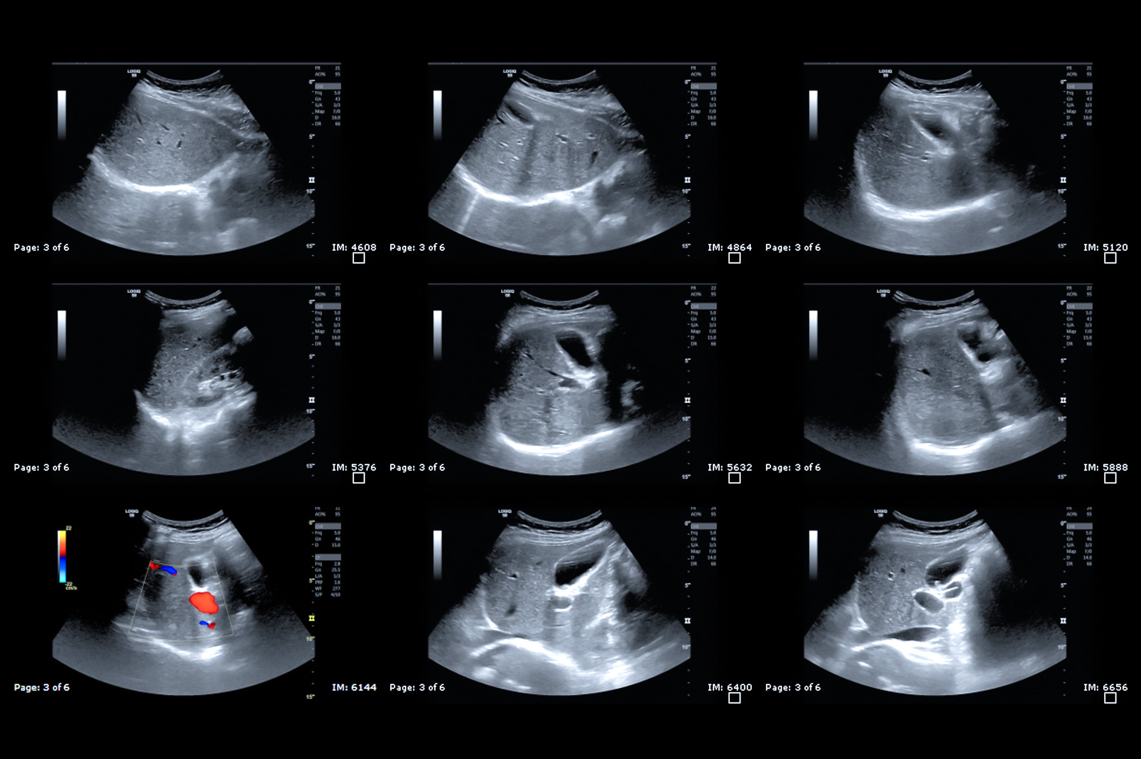 Ultrasonido en la parte superior del abdomen mostrando hígado y vesícula biliar para detección de carcinoma de células hepáticas.