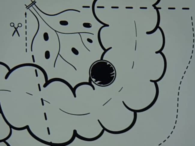 La operación consistía en extraer la parte afectada del intestino grueso.