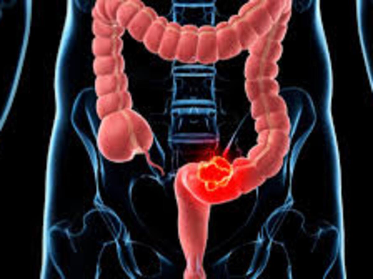 Cribado de cáncer de colon en Aragón, solo el 40% acude a la prueba pese a su sencillez y eficacia