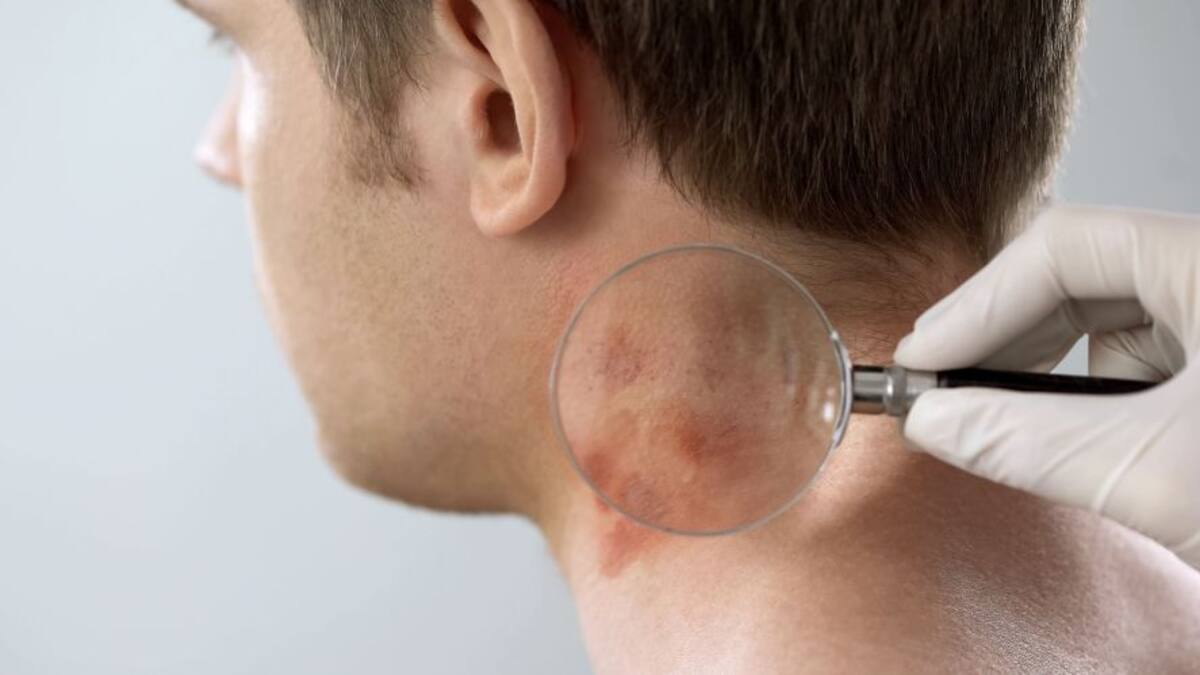 Qué es la psoriasis y cuáles son los tratamientos más efectivos y novedosos