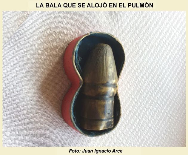 La bala que se alojó en el pulmón