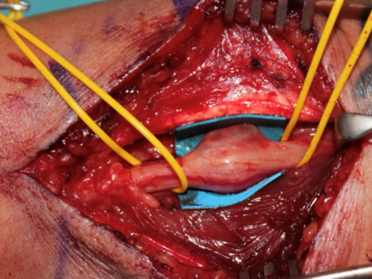 El Hospital de Getafe se convierte en referencia nacional para las cirugías de nervios en los brazos