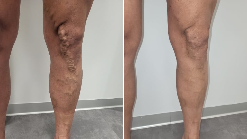 Piernas con varices: antes y después del tratamiento con fleboterapia