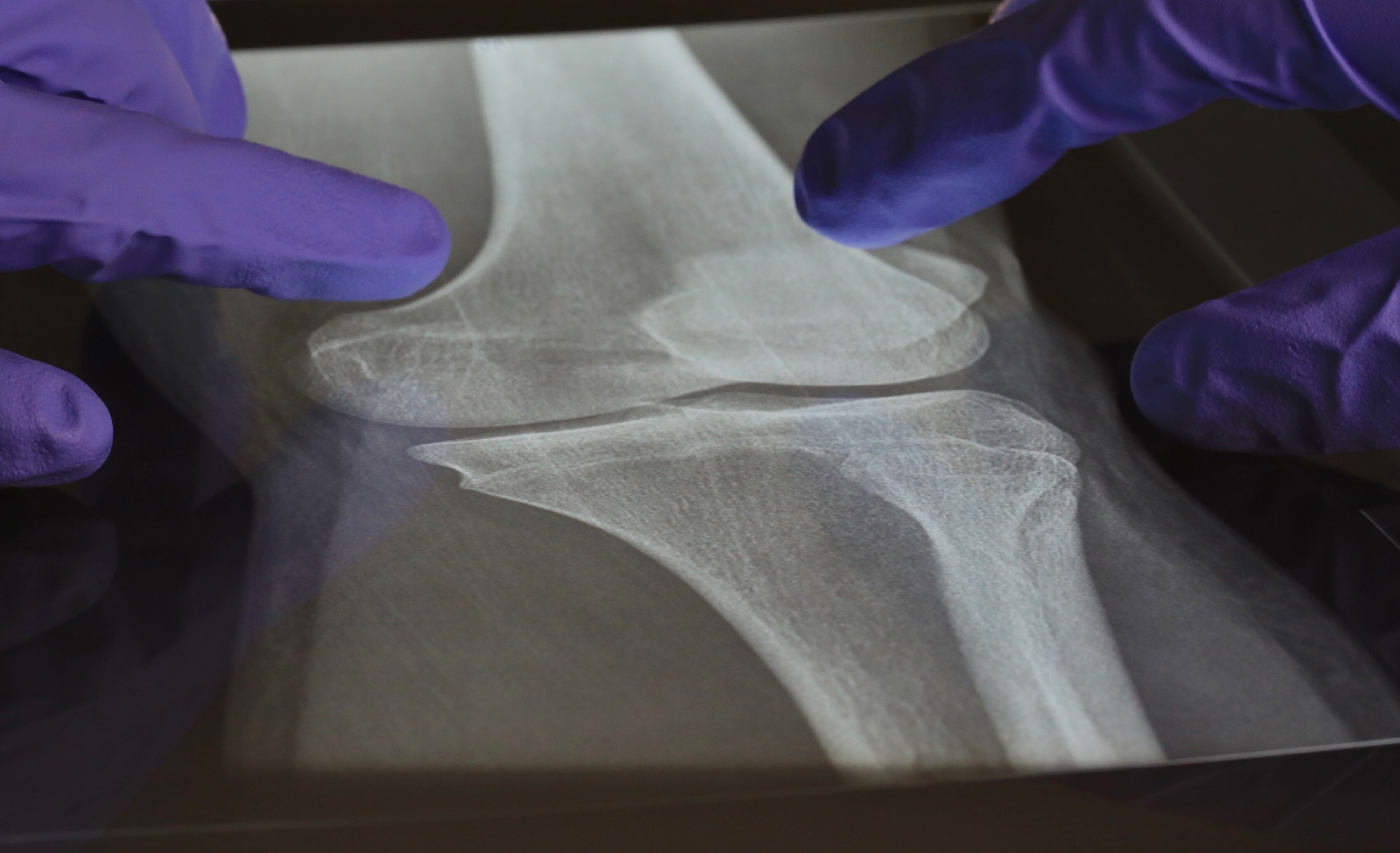 Radiografía rodilla