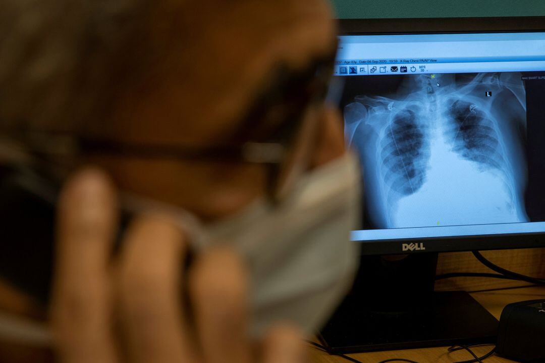 Radiografía de un paciente con COVID-19