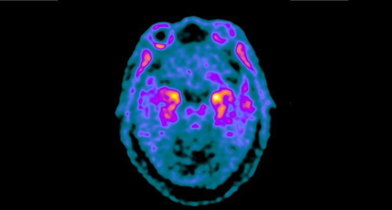 Imatge de PET-Tau en un pacient amb Alzheimer