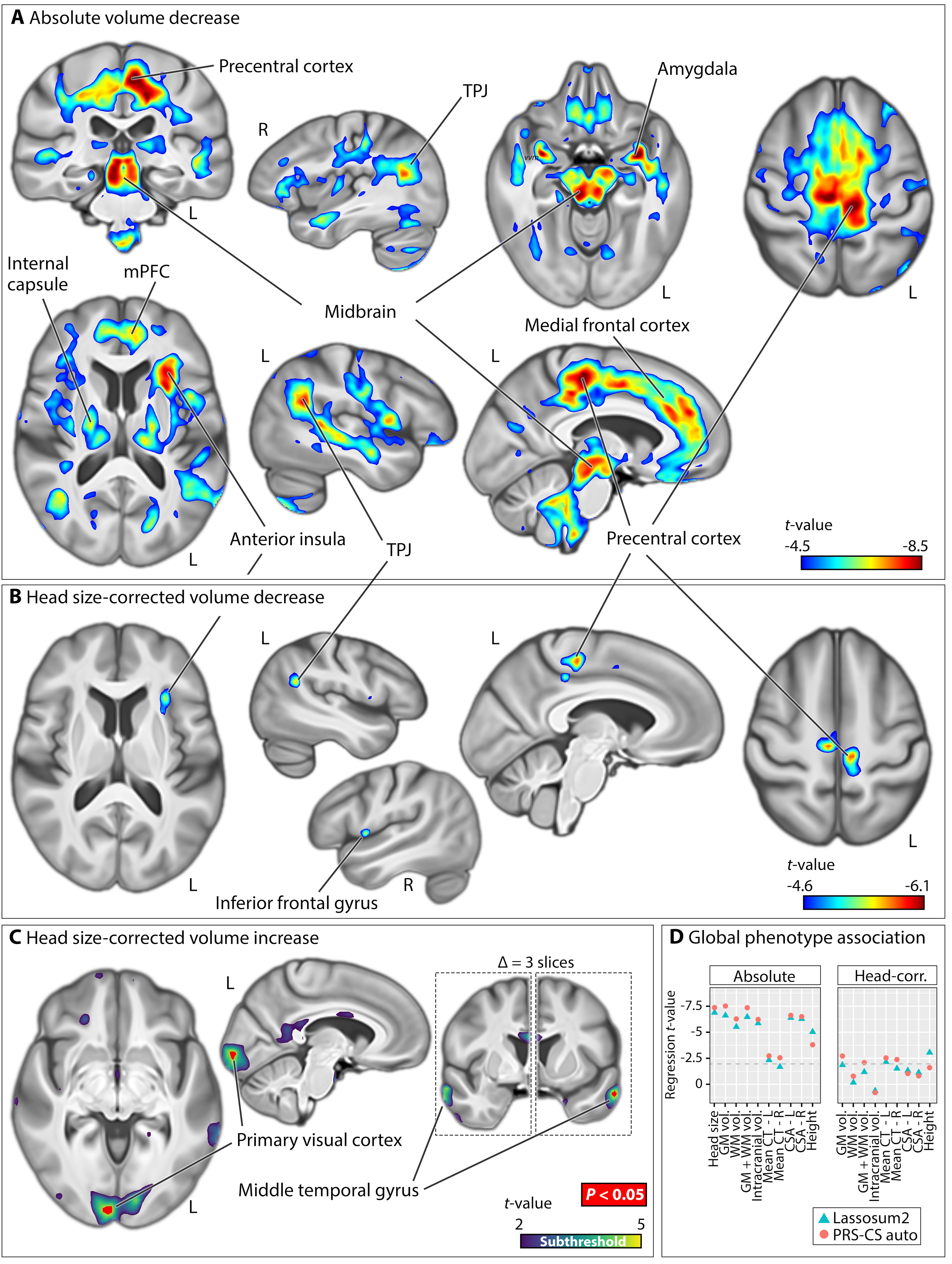 Asociaciones de los PGS de la dislexia con el volumen cerebral regional. 
Crédito
Soheili-Nezhad et al., Sci. Adv. 10, eadq2754 (2024)