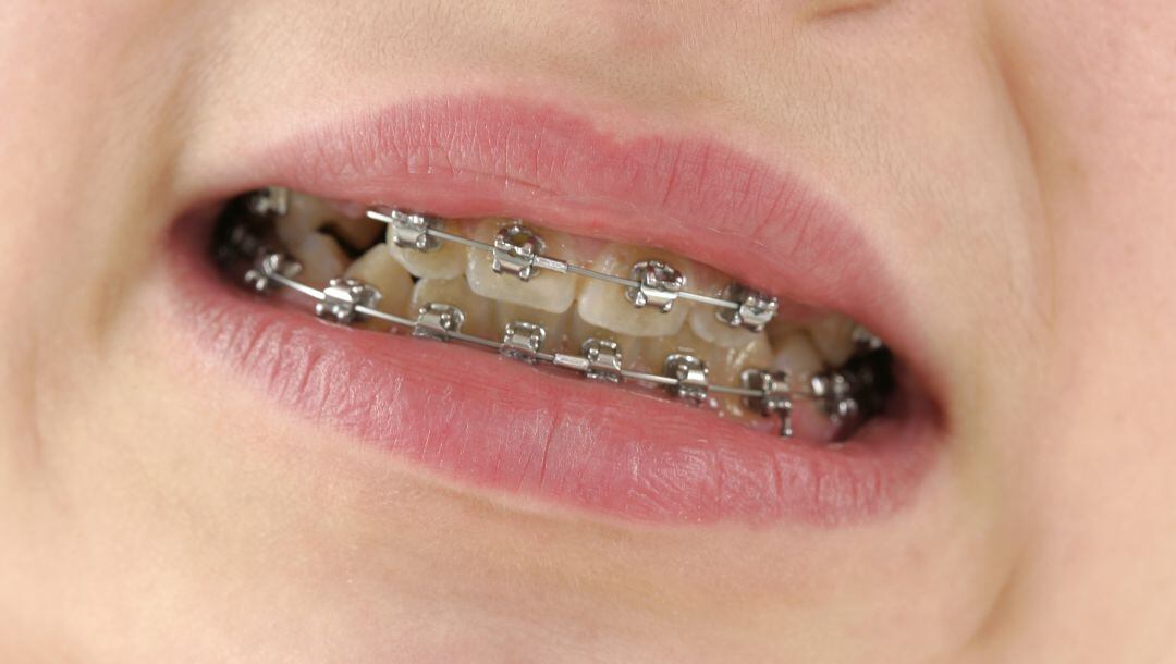 El acusado le arrancóa su pareja los brackets de un puñetazo