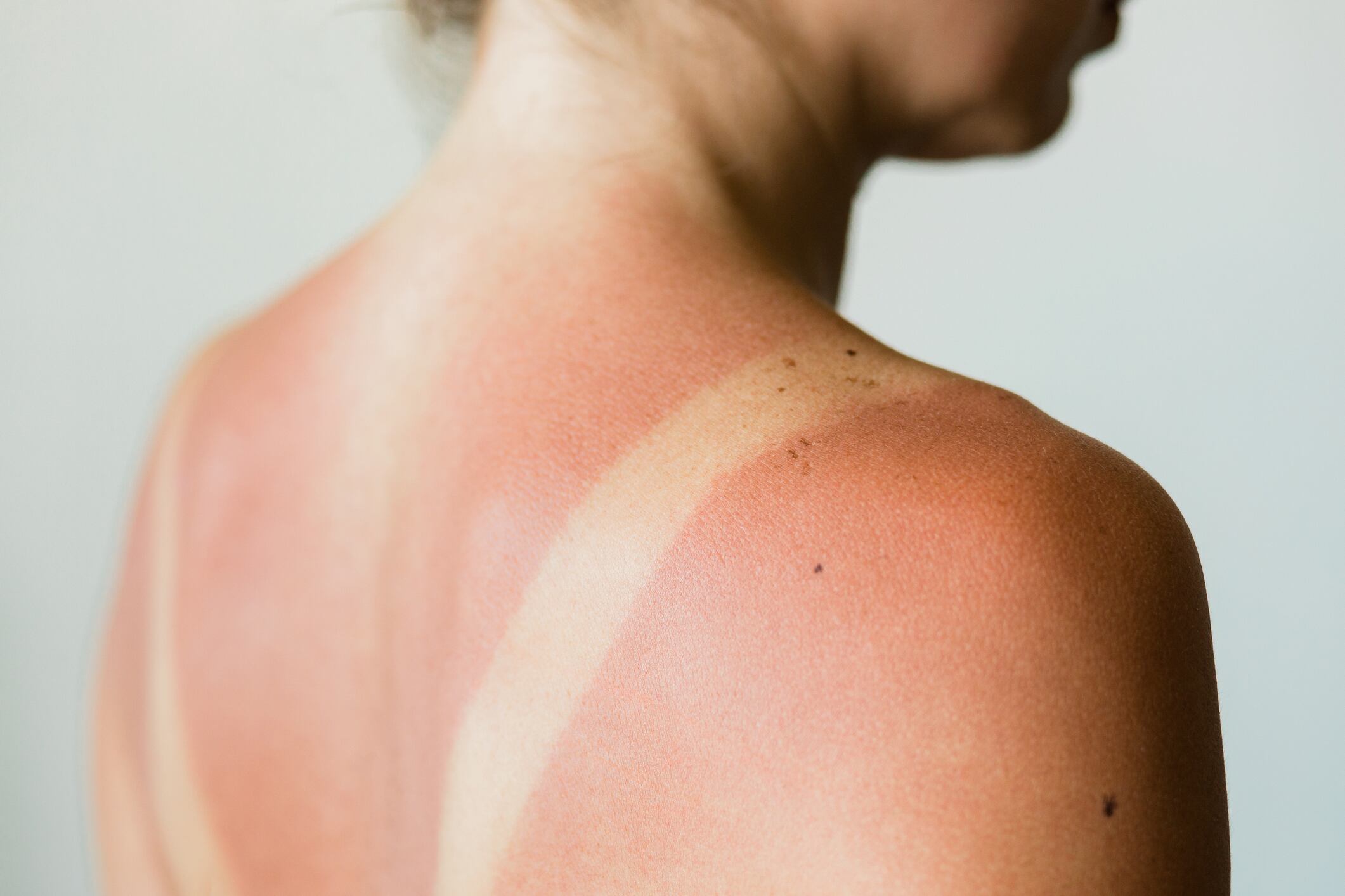 Una mujer con quemaduras en la piel, después de exponerse al sol.