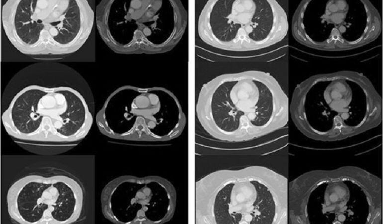 Distintos tipos en el análisis de la arteria coronaria.