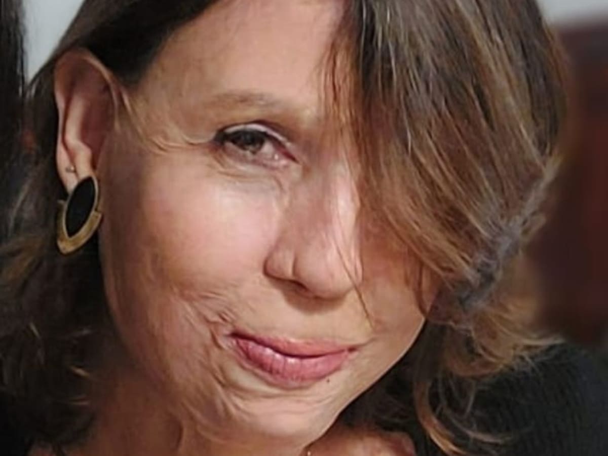 Natalia sufrió graves quemaduras con apenas año y medio: "Se pueden superar las barreras"