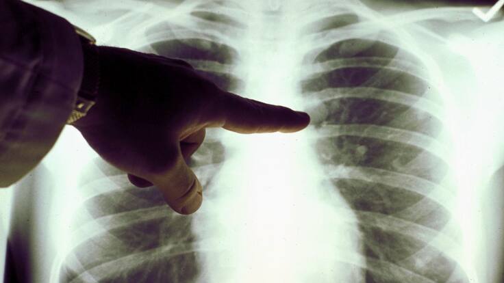 Gabi Otalora, de la asociación contra el cáncer, en 'La Ventana Euskadi'