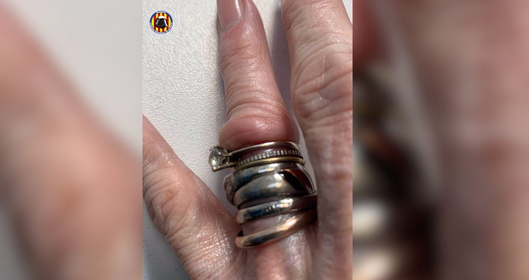 Bomberos retiran a una mujer seis anillos que aprisionaban su dedo anular