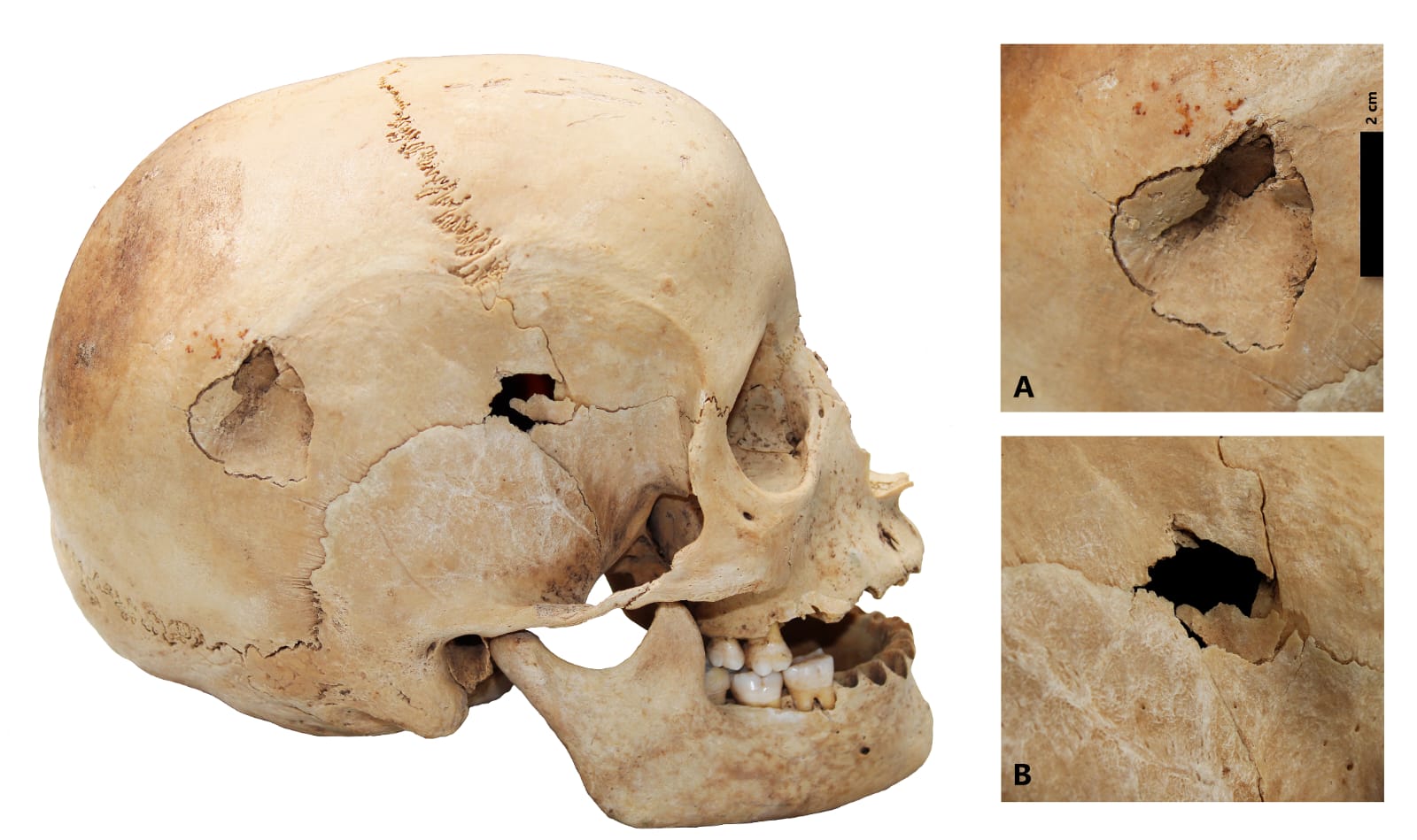 Lado derecho del cráneo de Los Jameos del Agua con  huellas de dos traumas letales.