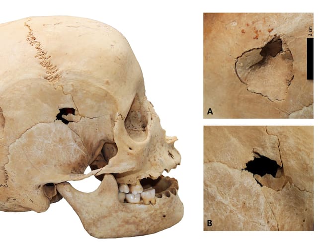 Lado derecho del cráneo de Los Jameos del Agua con huellas de dos traumas letales.