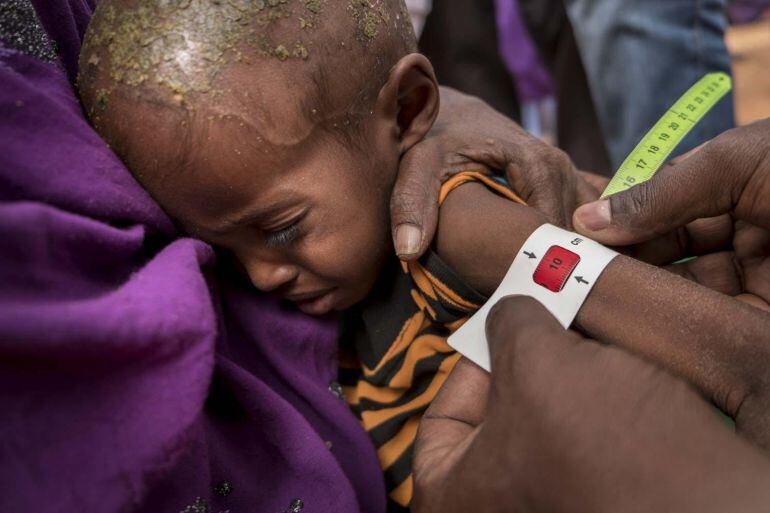 Ahmed, tiene 3 años, y pesa sólo 10 kilos, tuvo malaria y lleva así de enfermo un mes