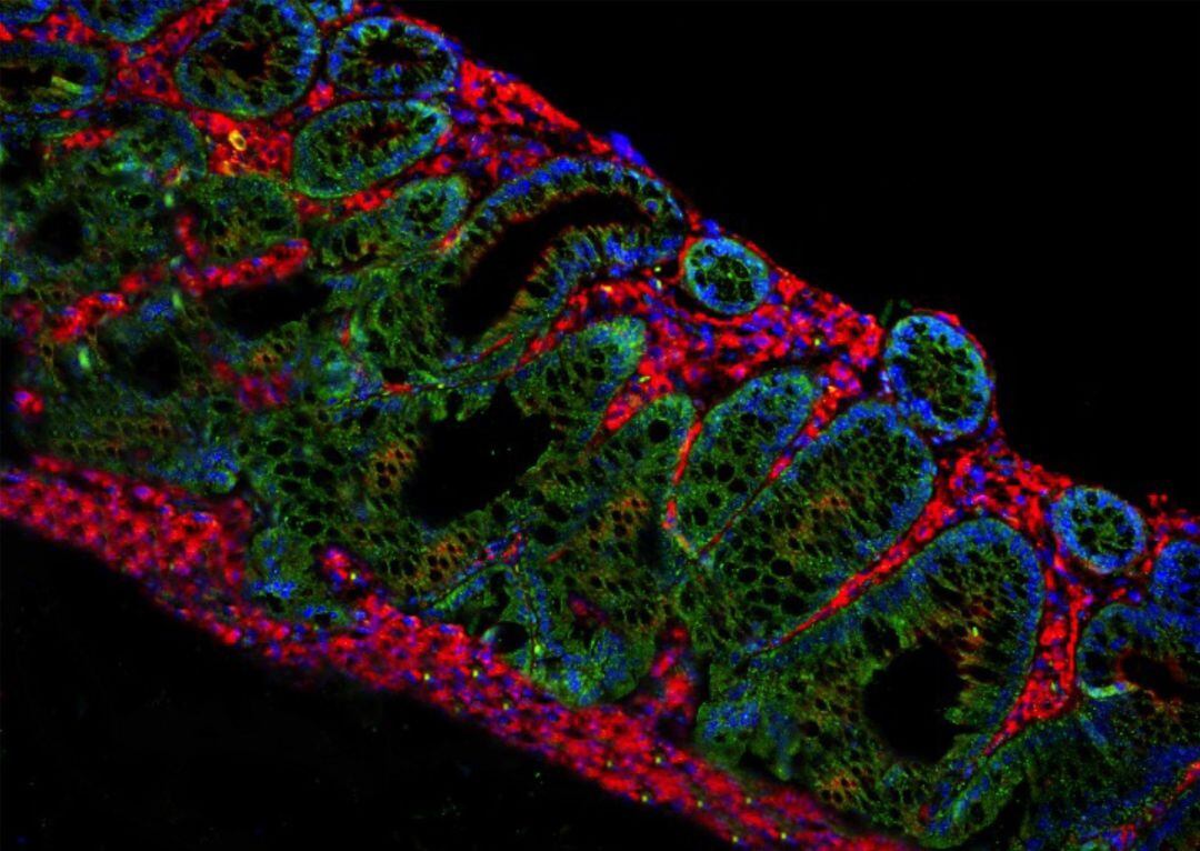 Identifican un mecanismo que promueve la progresión del cáncer cerebral más agresivo.