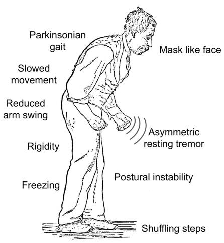 Los síntomas relacionados con el movimiento de la enfermedad de Parkinson. Imagen perteneciente a la obra &#039;Diseases of the Nervous System&#039;, de William Gowers