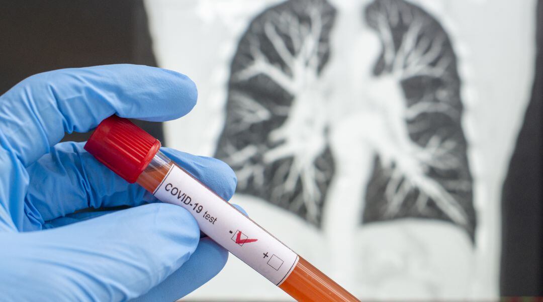 El número de casos activos asciende a 128