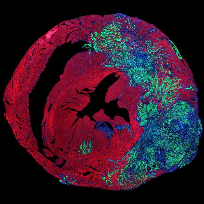 Imagen de células de cáncer de pulmón (en verde) creciendo en un corazón, donde los cardiomiocitos están teñidos de rojo y los núcleos de azul.
Crédito: Ciucci et al., Science 2026