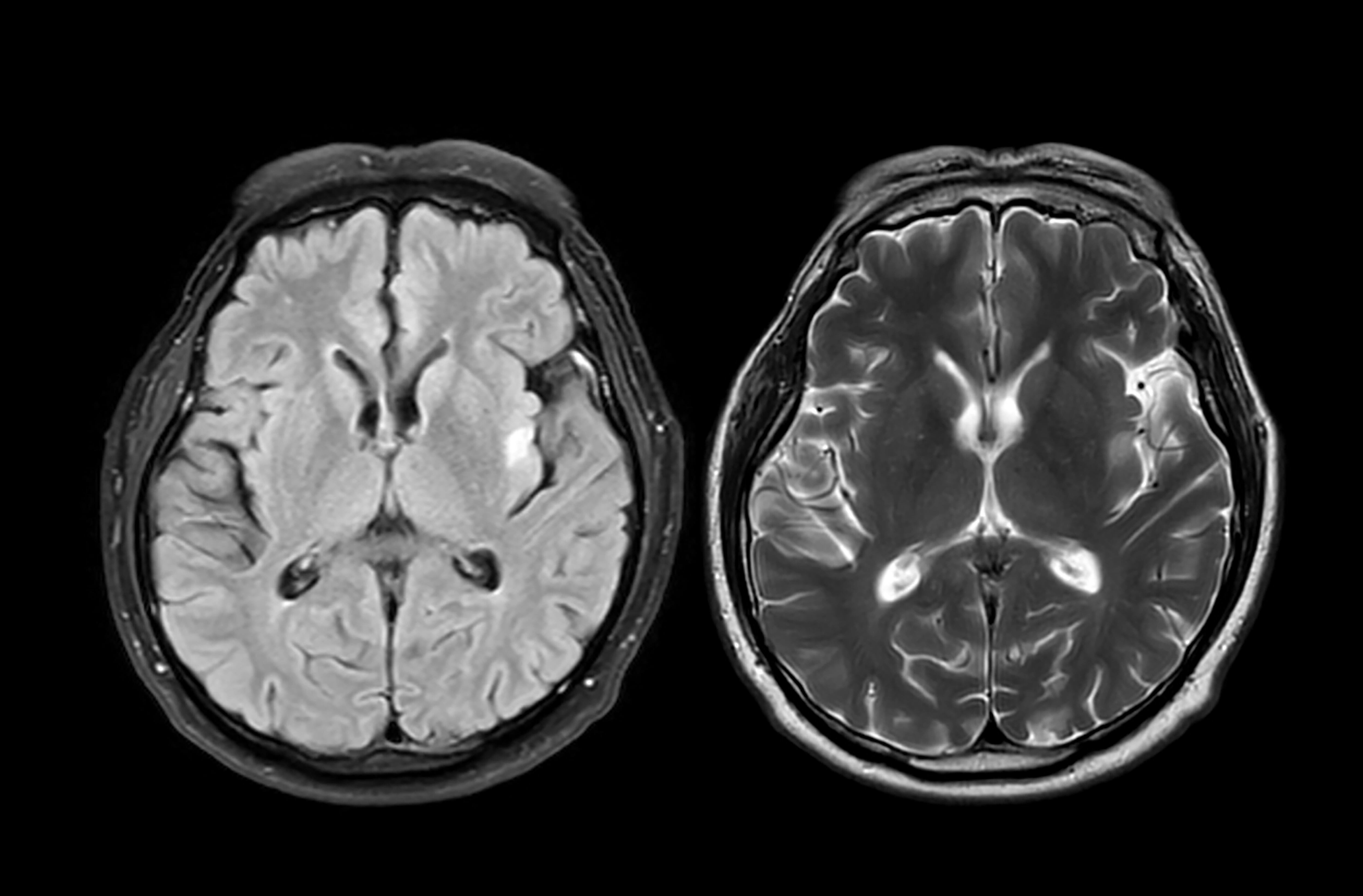 Descifran el mapa de proteínas que podría revolucionar la detección del párkinson y el alzhéimer.