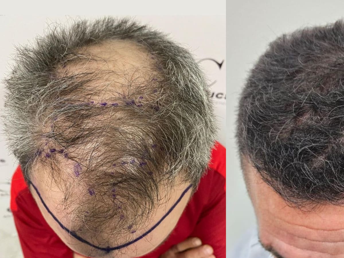 La normalización del injerto capilar avanza y Alfa Clinics consolida su modelo médico en Zaragoza