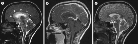 Les imatges mostren la hipertensió anormal que pateix el cervel pel consum deThermatrim