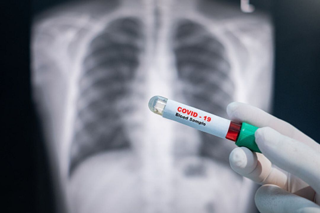 Prueba de coronavirus y radiografía torácica