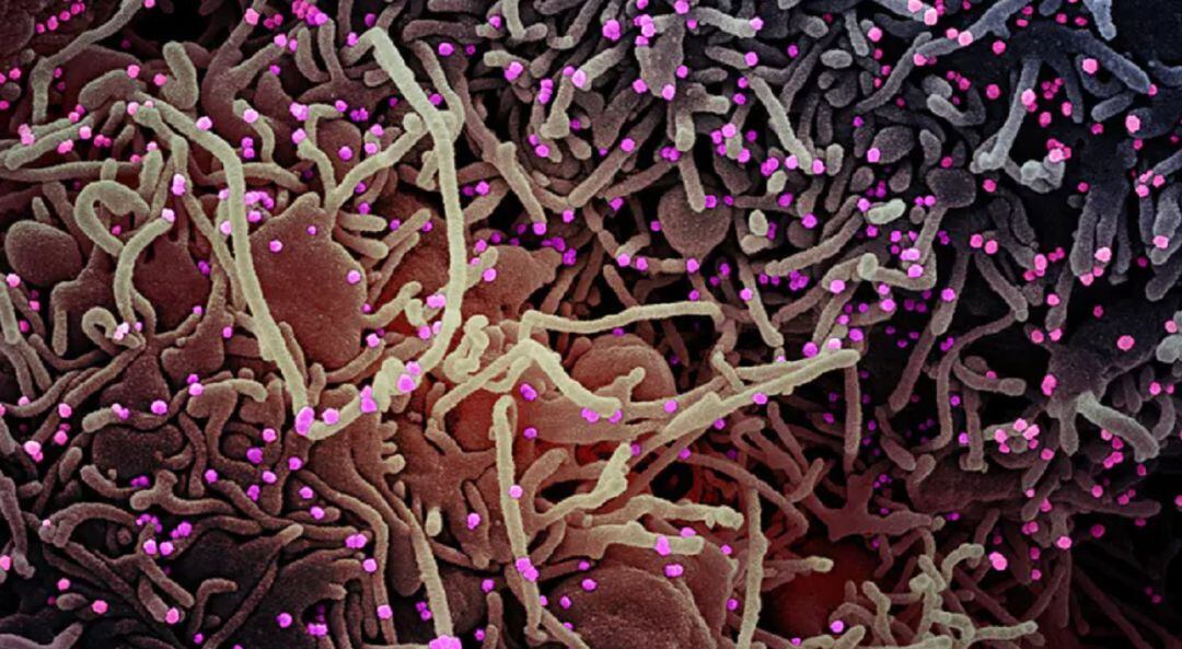 Coronavirus en el interior de una célula humana.