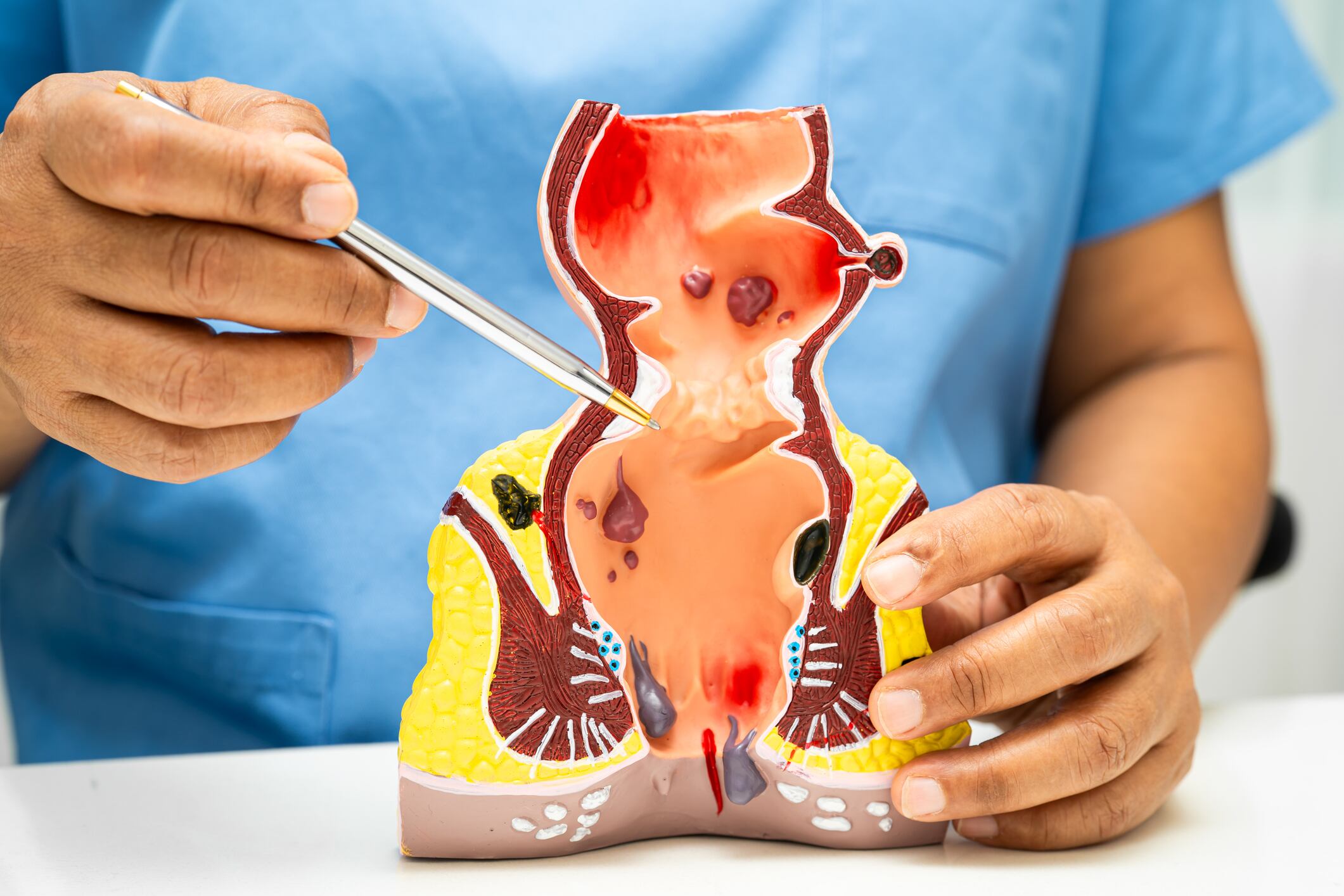 Un médico muestra las hemorroides en un modelo anatómico.