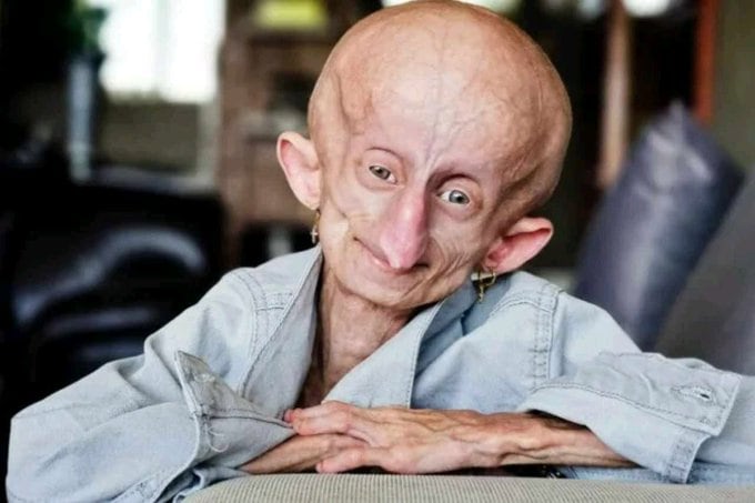 Beandri Booysen, influencer y exponente de la progeria en Sudáfrica