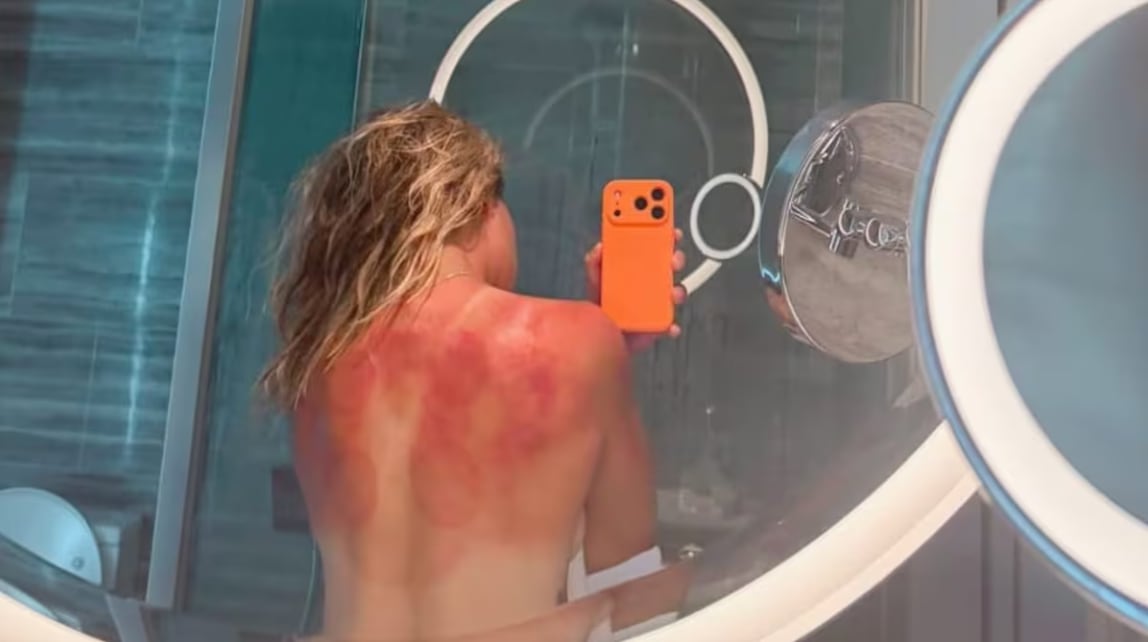 La tenista Zarazúa, con visibles quemaduras en su espalda