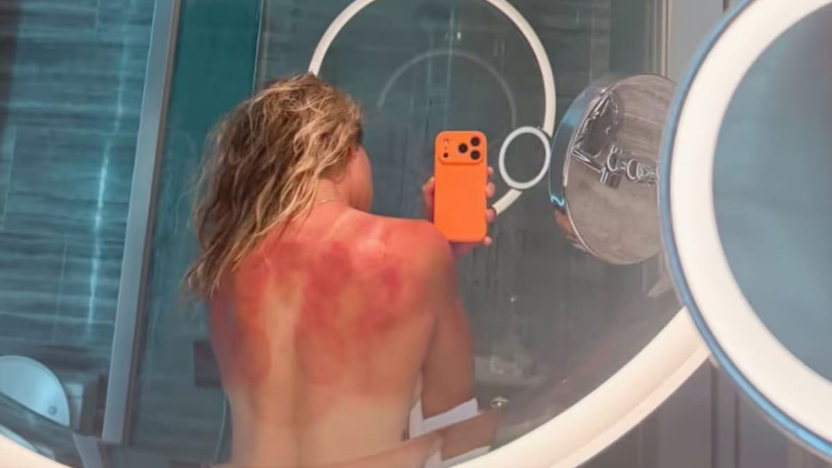 "No es una broma": la tenista Zarazúa muestra sus quemaduras por el sol en Australia