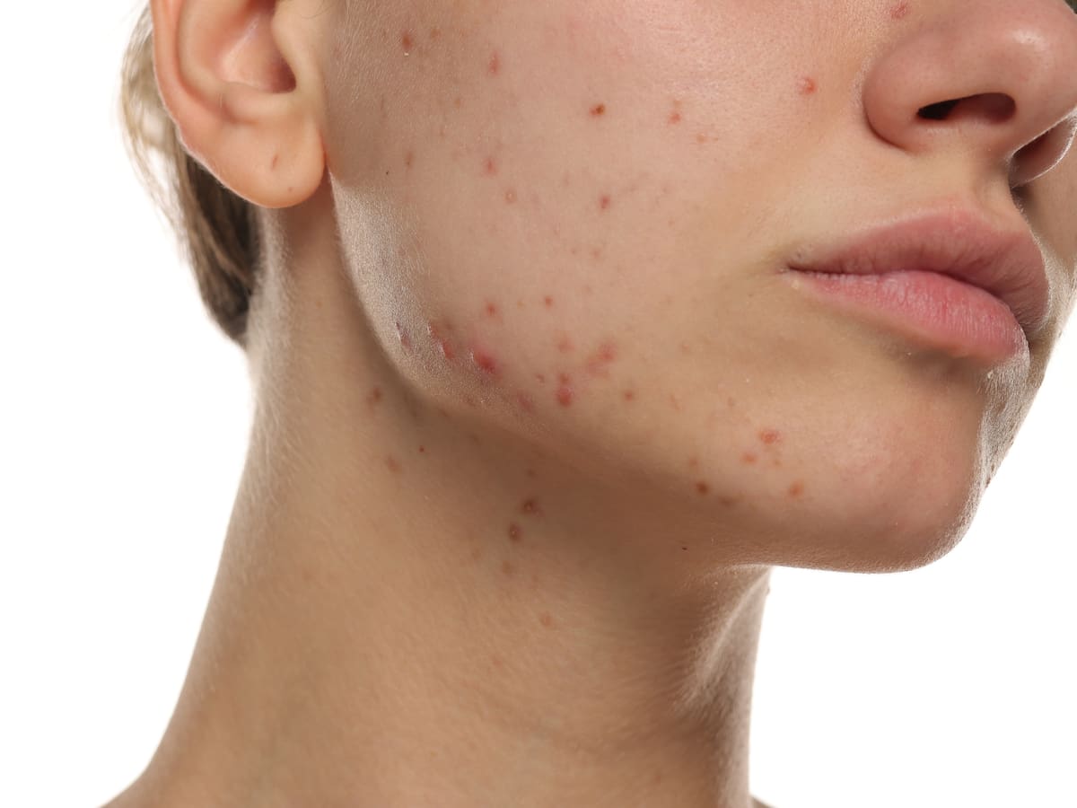 Intestino y piel: la relación que explica el origen del acné, la dermatitis y la rosácea