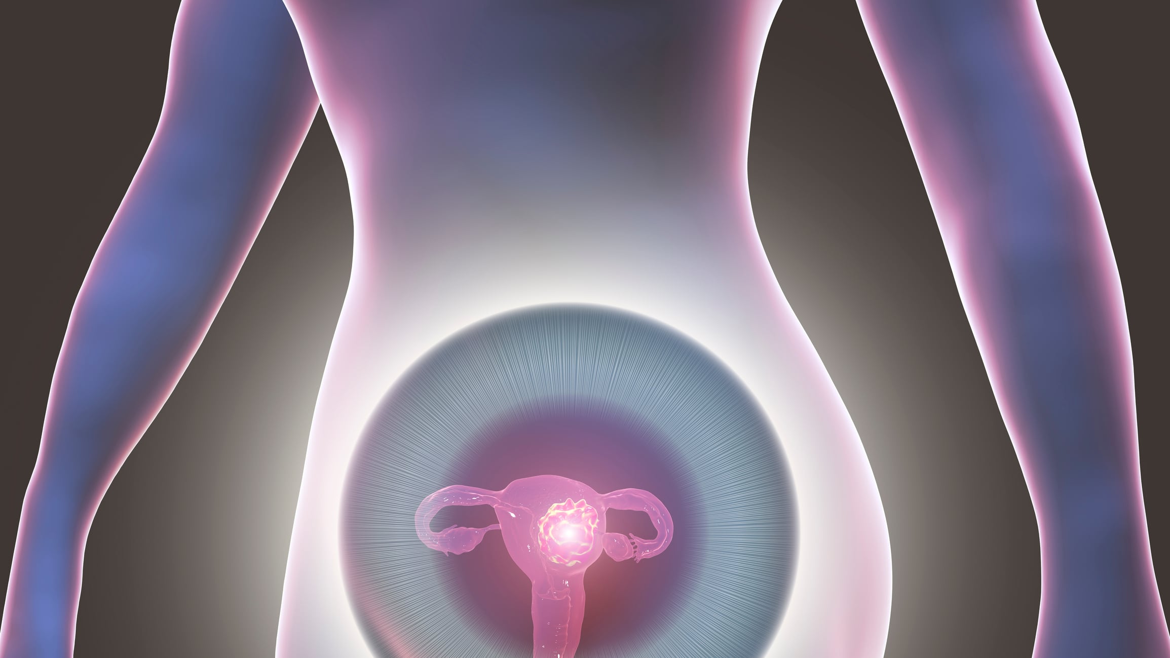 Uterine cancer, conceptual computer illustration.