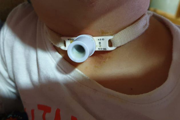 El pequeño Gabriel, de 3 años, sufre una traqueostomía desde que apenas tenía 20 días de edad
