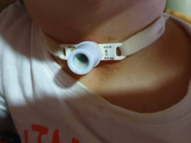 El pequeño Gabriel, de 3 años, sufre una traqueostomía desde que apenas tenía 20 días de edad