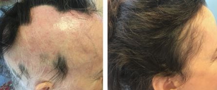 Alopecia areata en mujer de 51 años