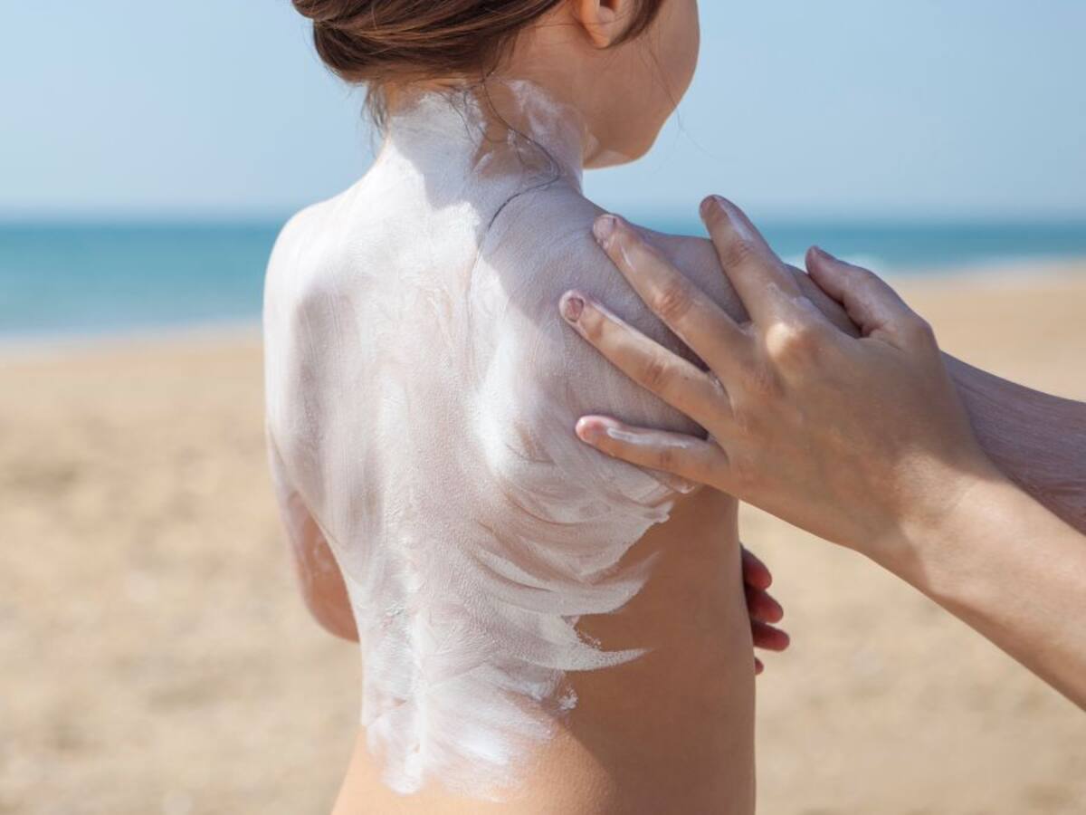 La piel es la sufridora del verano