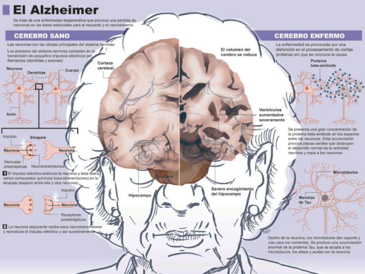 Científicos británicos desarrollan una vacuna contra el Alzhéimer