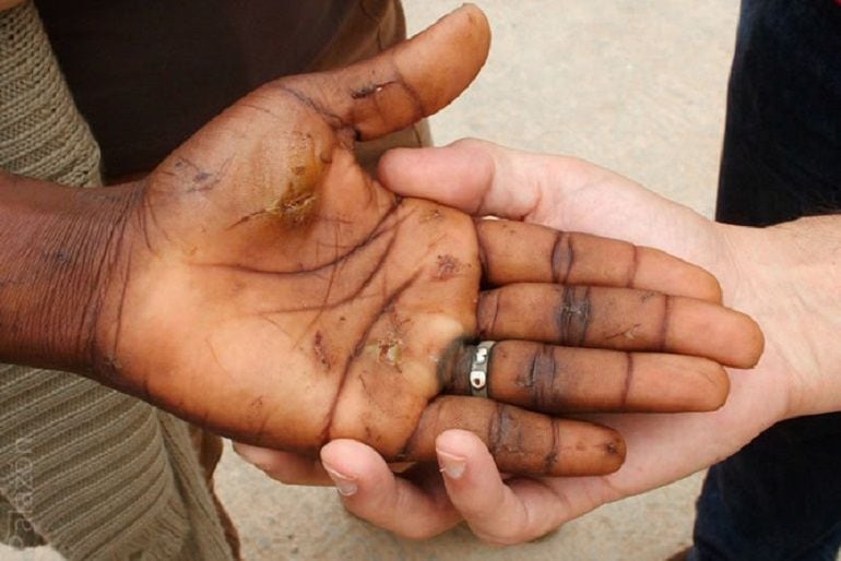 Consecuencias de las concertinas en la mano de un inmigrante.