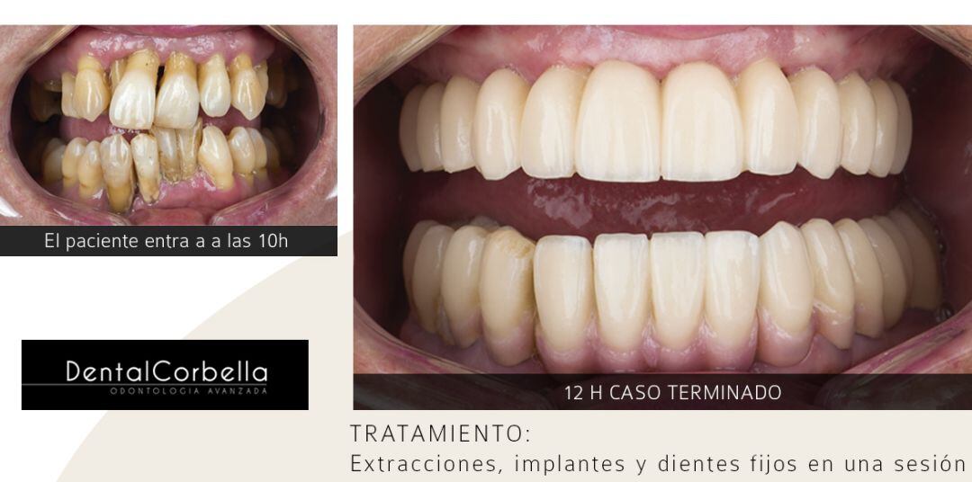 Expertos en implantología avanzada